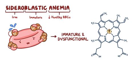 Sideroblastic Anemias .